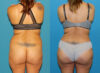 Brazilian Butt Lift case #4965 slider thumbnail