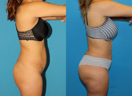 Brazilian Butt Lift case #4965