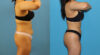 Brazilian Butt Lift case #4966 slider thumbnail