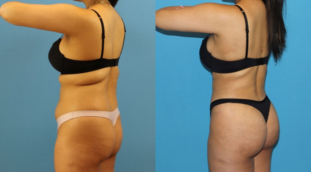 Brazilian Butt Lift case #4966