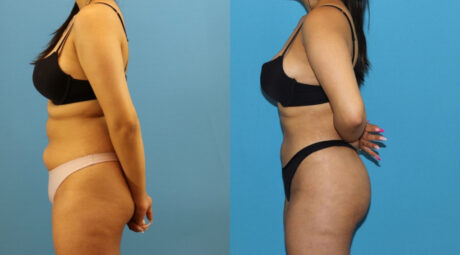 Brazilian Butt Lift case #4966