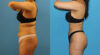 Brazilian Butt Lift case #4966 slider thumbnail