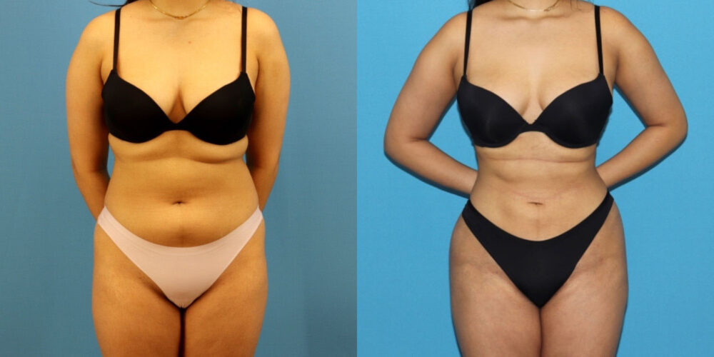 Brazilian Butt Lift case #4966