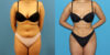 Brazilian Butt Lift case #4966 slider thumbnail