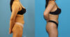 Brazilian Butt Lift case #4966 slider thumbnail