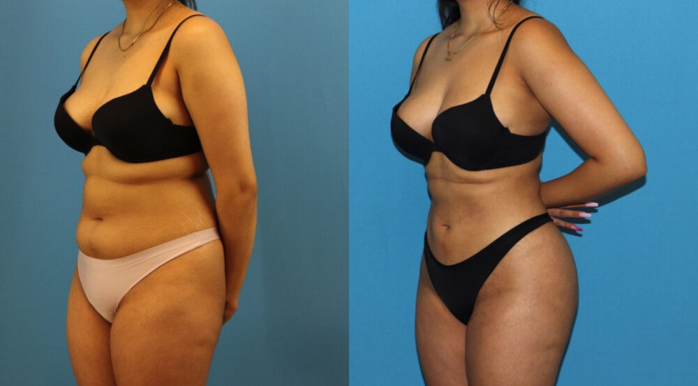 Brazilian Butt Lift case #4966