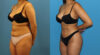 Brazilian Butt Lift case #4966 slider thumbnail