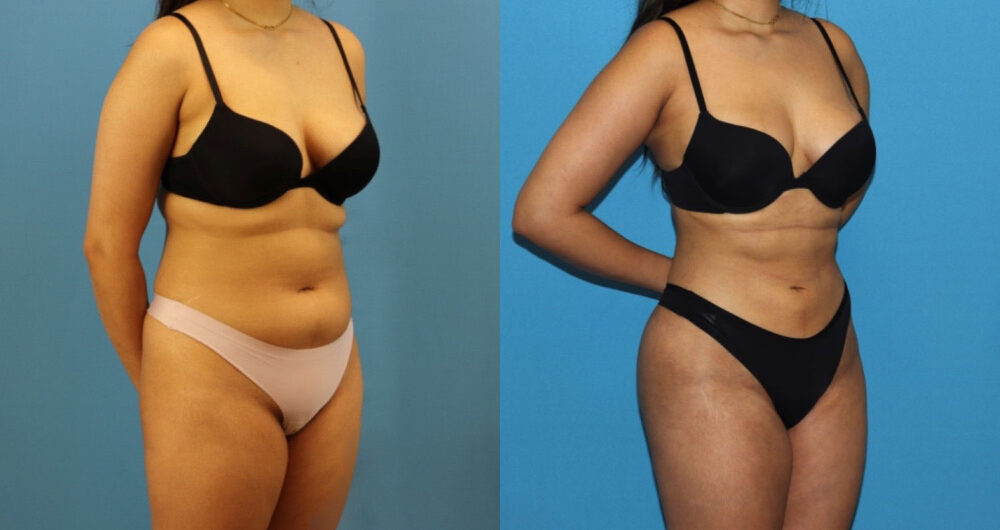 Brazilian Butt Lift case #4966