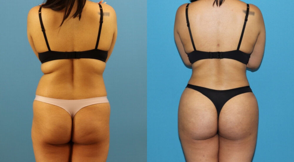 Brazilian Butt Lift case #4966