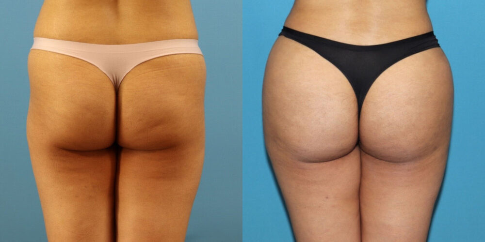 Brazilian Butt Lift case #4966