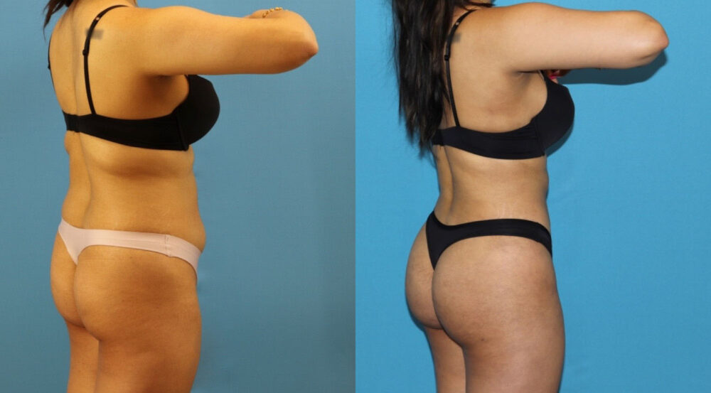 Brazilian Butt Lift case #4966