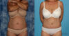 Tummy Tuck case #7086 slider thumbnail