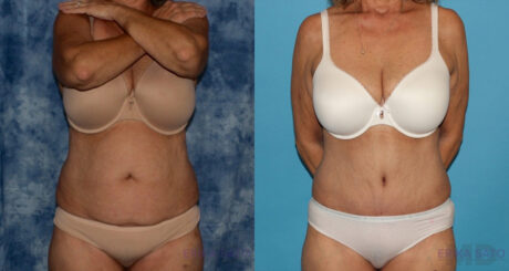 Tummy Tuck case #7086