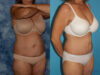 Tummy Tuck case #7086 slider thumbnail