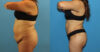Tummy Tuck case #7347 slider thumbnail