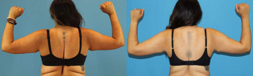 Tummy Tuck case #7347