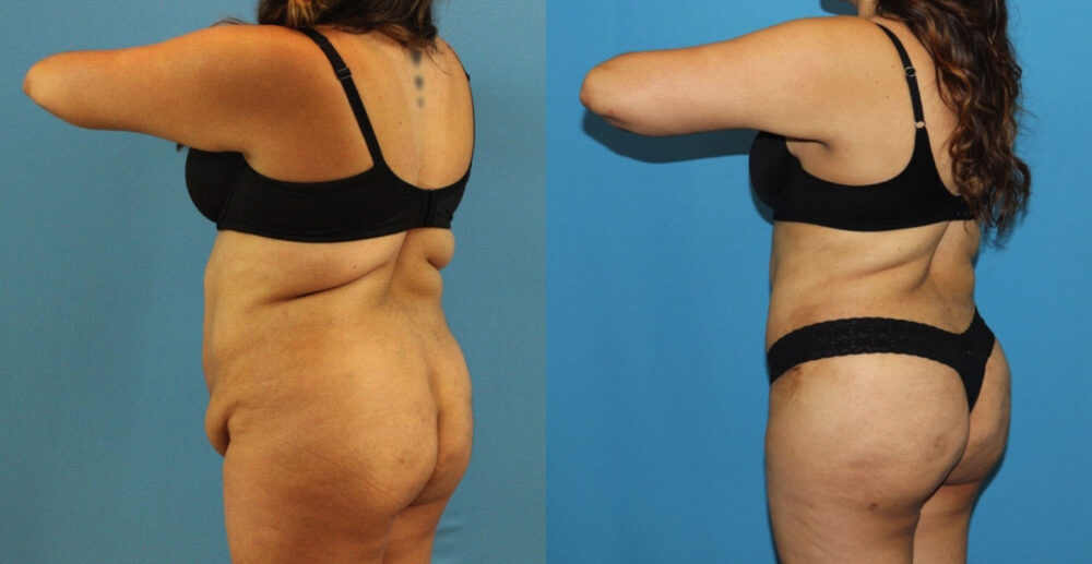 Tummy Tuck case #7347
