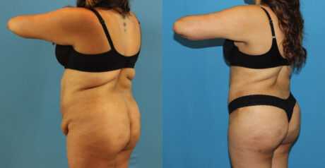 Tummy Tuck case #7347