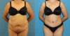 Tummy Tuck case #7347 slider thumbnail