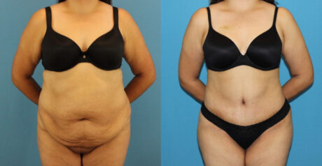 Tummy Tuck case #7347