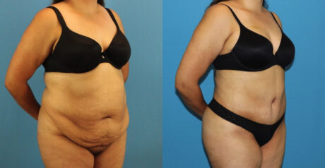 Tummy Tuck case #7347