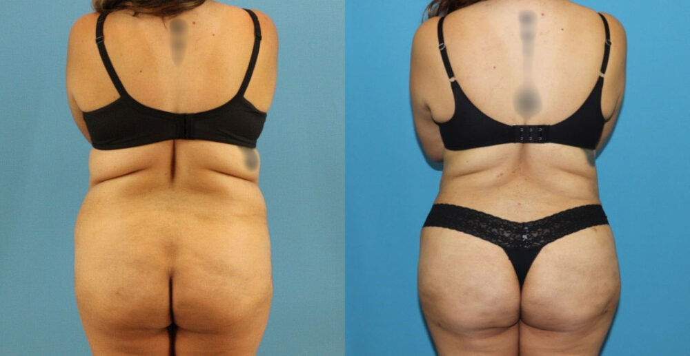 Tummy Tuck case #7347