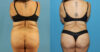 Tummy Tuck case #7347 slider thumbnail