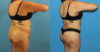 Tummy Tuck case #7347 slider thumbnail