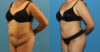 Tummy Tuck case #7347 slider thumbnail