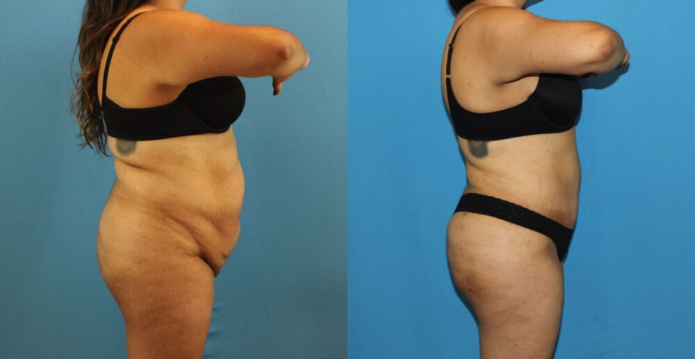 Tummy Tuck case #7347