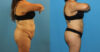 Tummy Tuck case #7347 slider thumbnail
