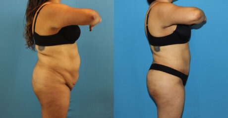 Tummy Tuck case #7347