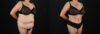 Tummy Tuck case #7774 slider thumbnail