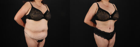 Tummy Tuck case #7774