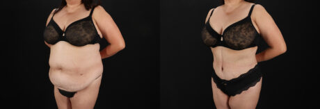 Tummy Tuck case #7774