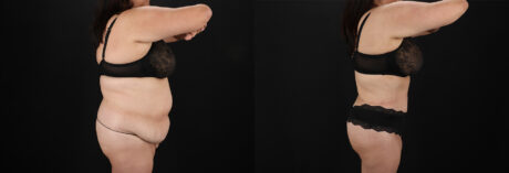 Tummy Tuck case #7774