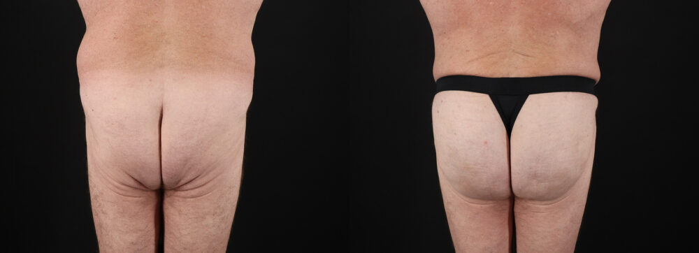 Brazilian Butt Lift case #5459