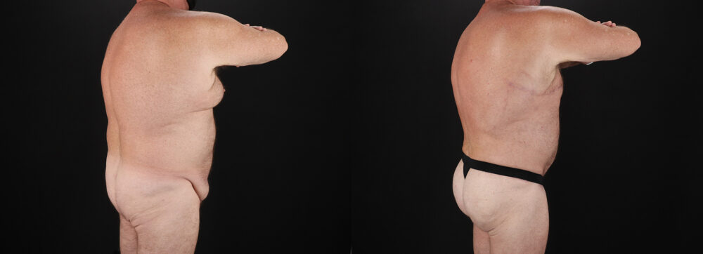 Brazilian Butt Lift case #5459