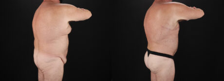 Brazilian Butt Lift case #5459