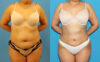 Liposuction case #6010 slider thumbnail