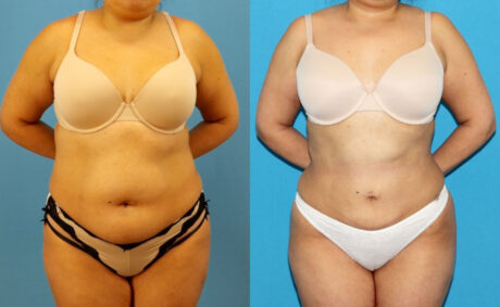 Liposuction case #6010