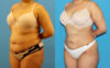 Liposuction case #6010 slider thumbnail