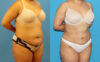 Liposuction case #6010 slider thumbnail
