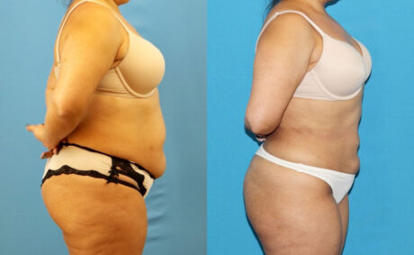 Liposuction case #6010