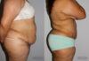 Tummy Tuck case #7085 slider thumbnail