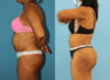 Tummy Tuck case #7348 slider thumbnail