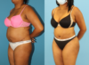 Tummy Tuck case #7348 slider thumbnail