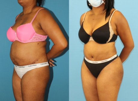 Tummy Tuck case #7348
