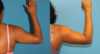 Tummy Tuck case #7348 slider thumbnail