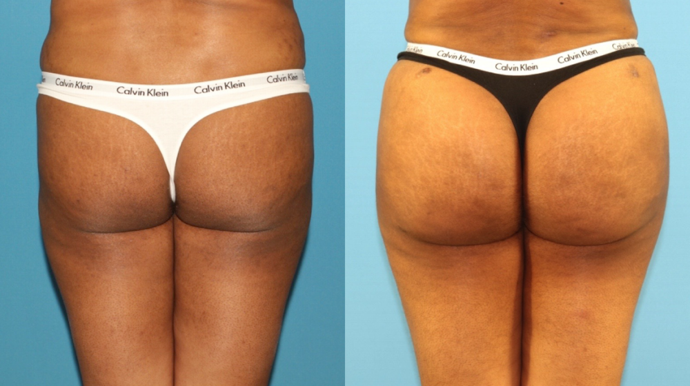 Tummy Tuck case #7348